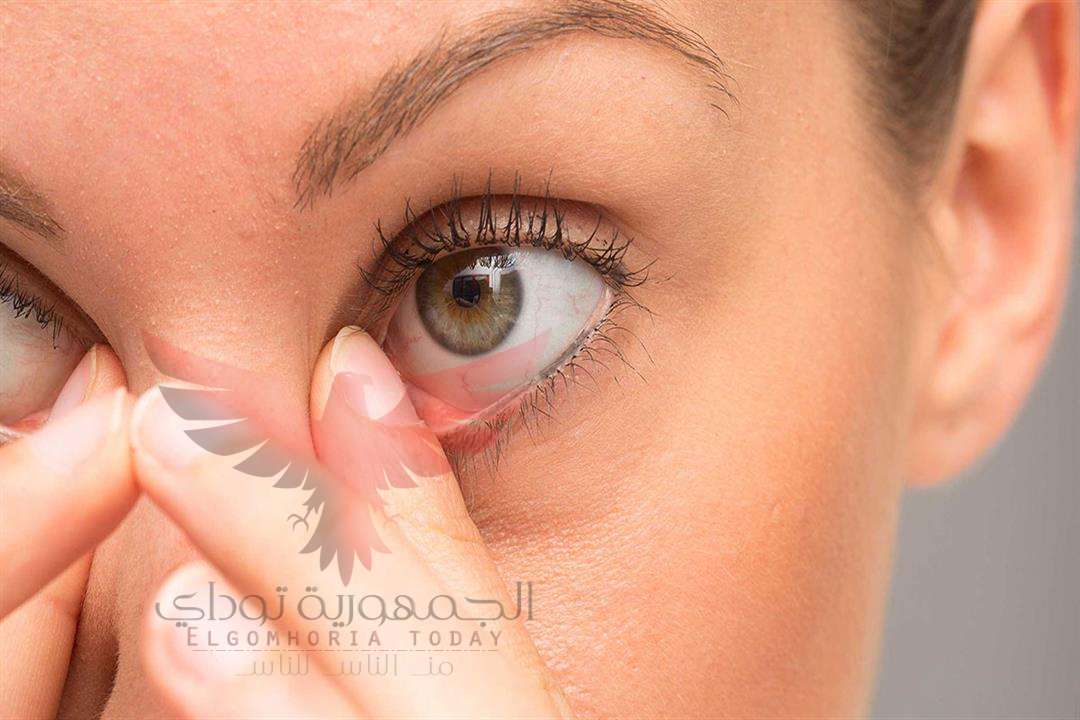 أسباب رفة العين